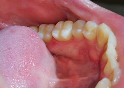 Kompozitna plomba posle