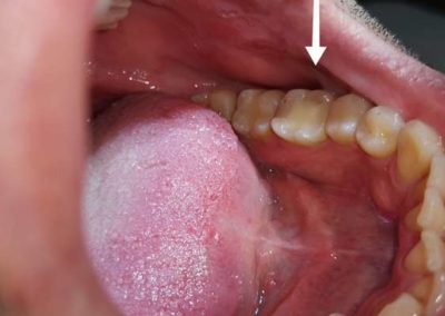 Kompozitna plomba pre