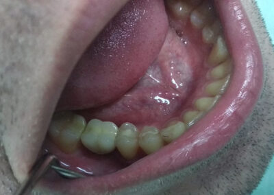 Implanti bocne regije