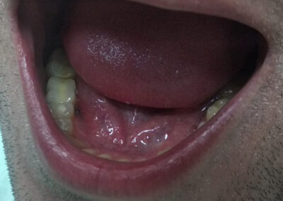 Implant bocne regije posle