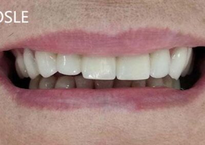 Kompozitna protetika