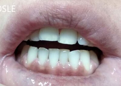 Kompozitne fasete posle