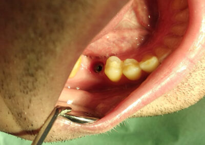 Pre ugradjivanja implanta