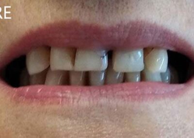 Kompozitna protetika