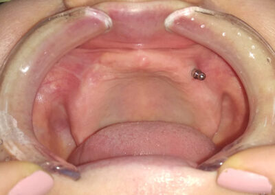 Potpuna bezubost pacijenta