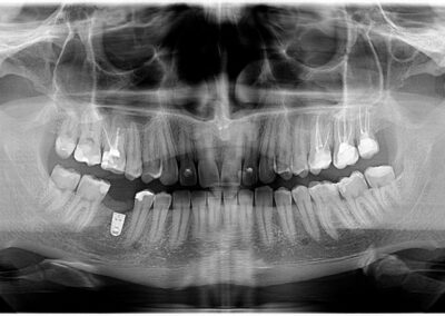 Prvi snimak zuba pre implanta