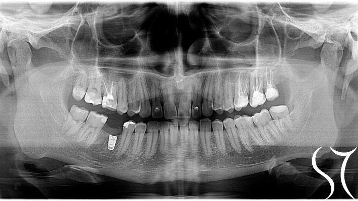 Prvi snimak zuba pre implanta