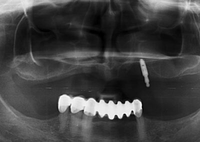 Snimak vilice pre proteze