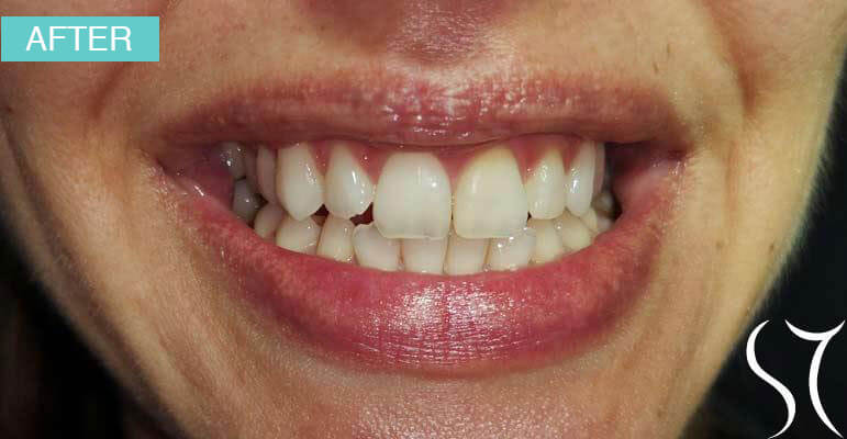 beljenje-avitalnih-zuba-en