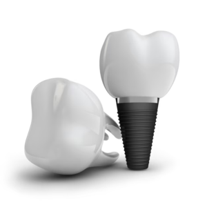 Zašto sve više ljudi u Srbiji i regionu bira Neodent implante?