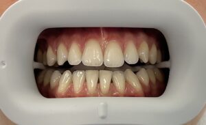 beljenje zuba u novom sadu cena