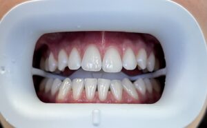 beljenje zuba u novom sadu preporuka 