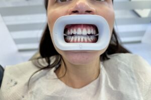 Ordinacijsko beljenje zuba – Iskustvo iz Smile Time ordinacije