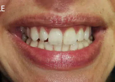 Beljenje avitalnih zuba posle