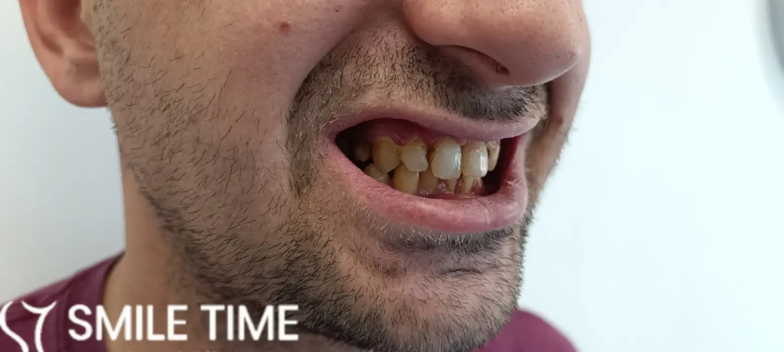 Popravka Zuba
