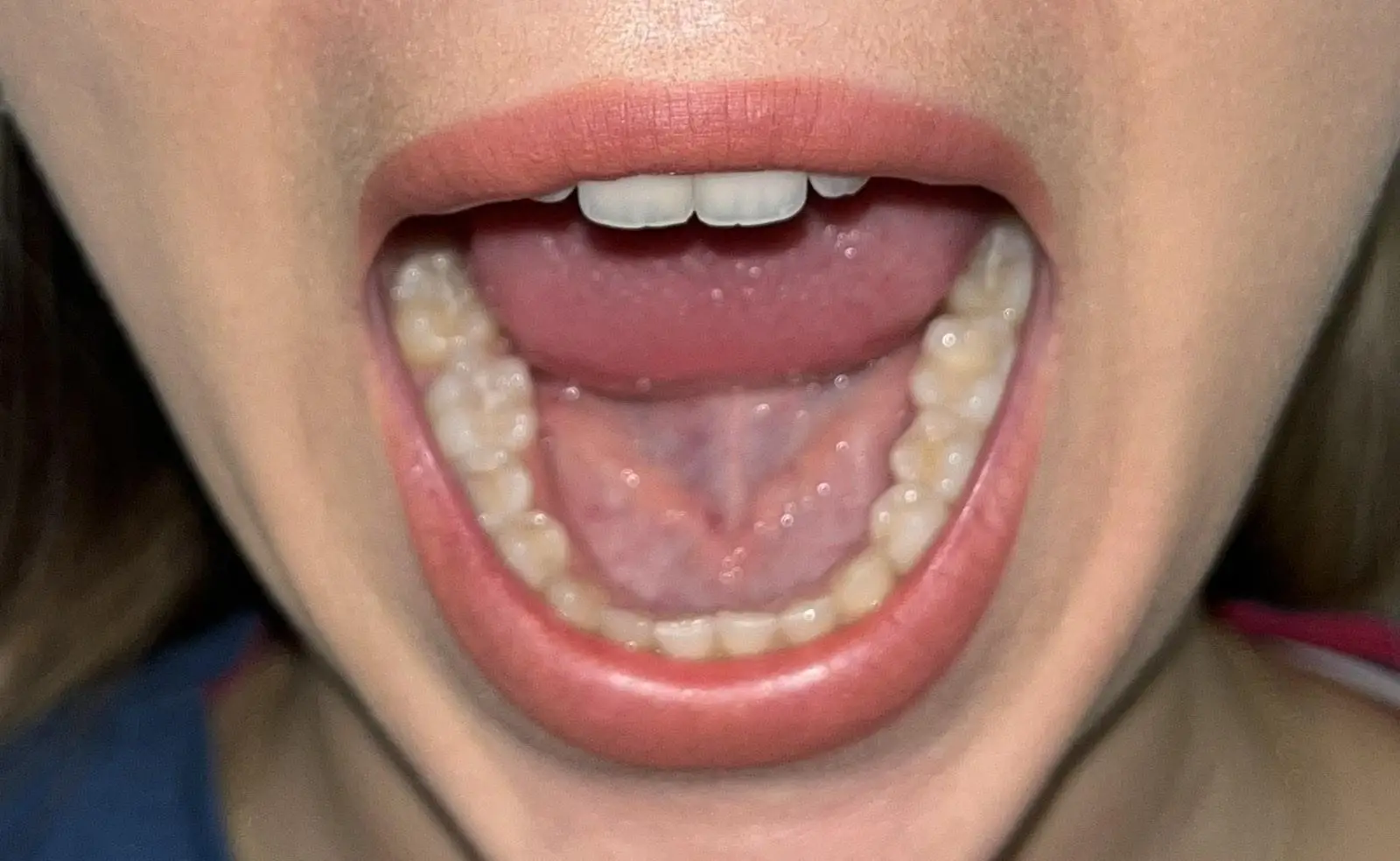 Popravka Zuba