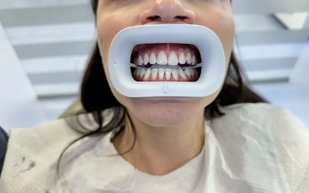 Ordinacijsko beljenje zuba – Iskustvo iz Smile Time ordinacije