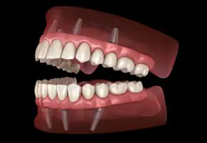 all on 4 zubni implanti cena novi sad preporuka Šta najviše muči pacijente prema diskusijama na Dental Town platformi?