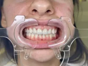 rekonstrukcija osmeha u smile time zubnoj ordinaciji