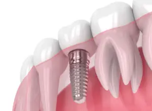 preporuka za zubara za zubne implante cena implanata u novom sadu preporuka
