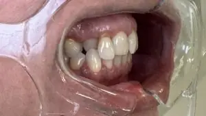 Korekcija položaja gornje desne trojke i dvojke bez ortodoncije Novi Sad zubna ordinacija