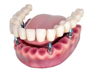 all on 4 zubni implanti cena u novom sadu i preporuka za zubara all on 4 cena